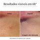 Clear & Defend+ Patches para Borbulhas para Pele Sens&iacute;vel - NEUTROGENA -  - Imagem 5
