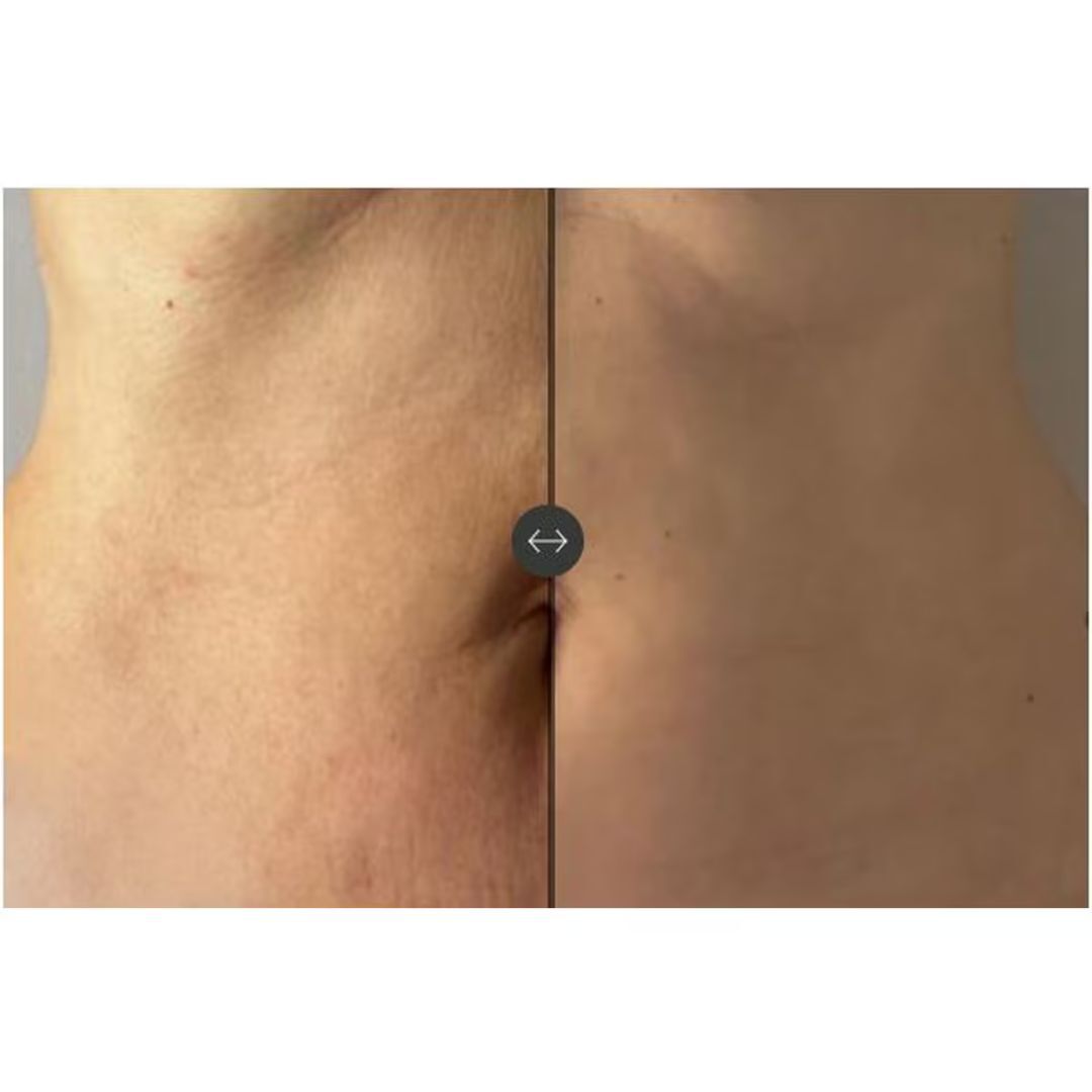 UNICTECH BODY SLIM x4 - UNICSKIN - Techno Beauty - Imagem 5